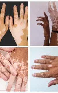 مگه من مرده باشم تو بیماری پوستی داشته باشی