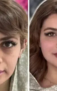آفر ویژه ،تزریقات فیلر،بوتاکس850در منزلِ شما