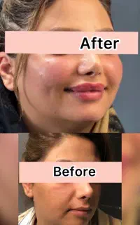 تخفیف۵۰درصد.بوتاکس۸۰۰ژل۹۰۰مزومزوژلprp پزشک