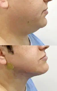 عمل غبغب و لیفت صورت توسط پزشک فوق تخصص جراحی