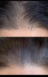 مزوتراپی و prp توسط پزشک