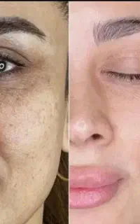 جشنواره تضمینی/تخصصی لک/PRPفقط۸۰۰/فقط تاامشب