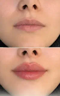مزو، بوتاکس،چربی، فیلر،جراحی و زیبایی صورت