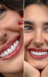 جشنواره دندان ونیر کامپوزیت روکش لمینیت عصب  IMAX