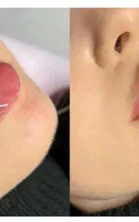 ژل و بوتاکس مزو جوانساز پی آرپی