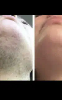 لیزر ۲۰۰