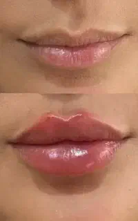 آموزش و تزریق بوتاکس فیلر مزونیدلینگ خالبرداری
