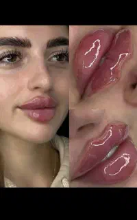 اموزش ژل و بوتاکس با متد جدید یک جلسه رایگان