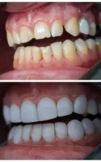 کامپوزیت و عصب کشی و روکش دندانپزشکی