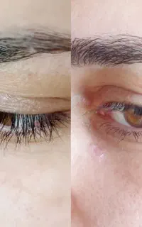 خالبرداری،میخچه ،زگیل فقط بامحلول گیاهی