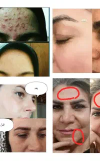 درمان جوش،لک در یک دوره