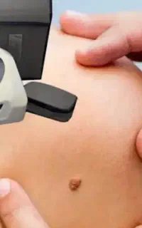 خالبرداری و برداشت زگیل و کک و مک در مطب