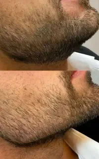 فیلر اصل اصل مزو بوتاکس آنزیم برداشتن خال از ۱۰