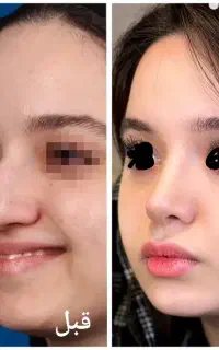 جراحی زیبایی بینی-ارومیه-تخفیف ویژه