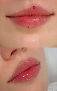 فیلر لب، زاویه سازی و جوانسازی با فرم طبیعی