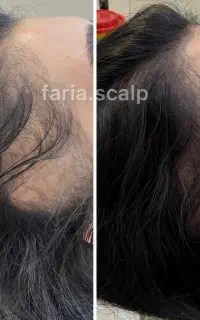 میکرواسکالپ سر،رفع کم پشتی جشنواره پاییزه