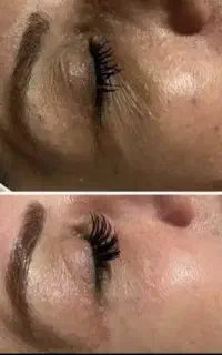 اگزوزوم تراپی ،فی نیدلینگ ،پپتاید تراپی دستگاه EPN