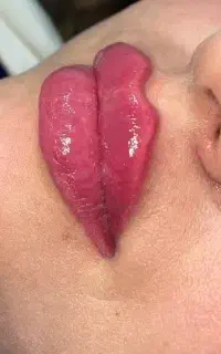 فیلر،مزوژل،بوتاکس