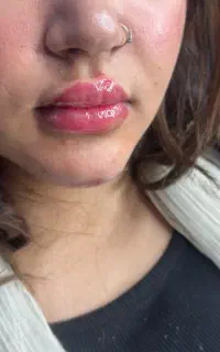 خدمات فیلر بوتاکس پی ارپی لیفت نخ فیلر بادی