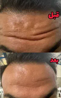 بوتاکس طبیعی