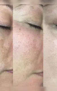 پاکسازی تخصصی و درماپلینگ