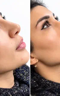 جشنواره تخفیفی ژل بوتاکس مزو نخ