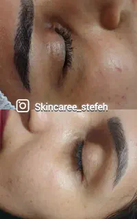 پاکسازی ، فشیال و درمان اصولی در کلینیک با تخفیف