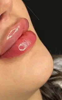 ژل وبوتاکس،فیبروز،شیدینگ،مزوژل،مزوومزونیدلینگ