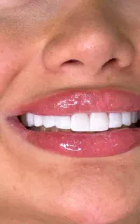 دندانپزشکی،کامپوزیت، لمینیت