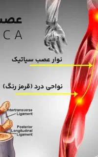 د رما ن دردهای شدید کمر و زانودیسک سیاتیک کتف و...