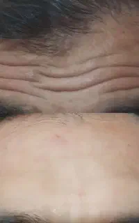آف ژل وبوتاکس تضمینی(خانمهاوآقایان)