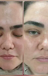 حذف کک ومک تک جلسه ای،حذف موهای زائد