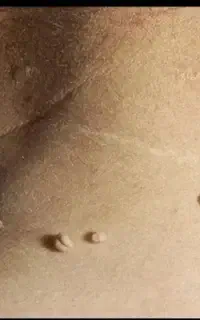 جشنواره تخفیفی لیزر خال،نشانه ومنگوله گوشتی،کک ومک