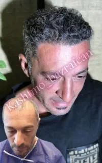 کاشت مو توسط دکتر اهل شیراز در تبریز