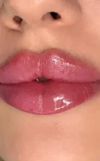 ژل و بوتاکس