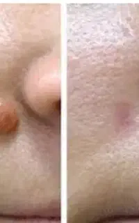 خال.کک ومک.خال های گوشتی.میخچه
