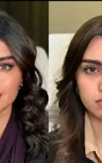 ساکشن غبغب با متد«ایرانا» دکتر کامبیز محمدپور