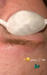 ریموو(پاک‌کردن)تتو ابرو با لیزر تخفیف50درصد(ایرانا