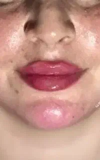 آموزش و تزریق ژل و بوتاکس