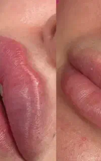 تزریق ژل و بوتاکس