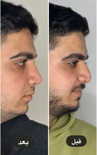 عمل زیبای بینی