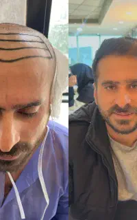 تضمینی موهاتو فول تراکم بکار+پی ار پی مزو بوتاکس