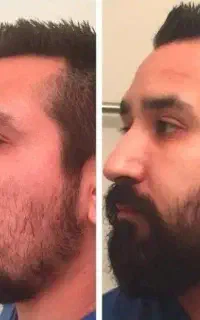 افزایش ریش