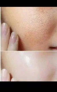 کرم ضدلک قوی و سفیدکننده پوست صورت