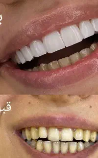 خدمات کامپوزیت ۵ساله با گارانتی  فقط ۱۲