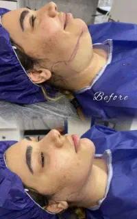 انواع جراحی های زیبایی بلفارو و ساکشن غبغب