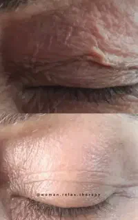 فیان جوانساز صورت رفع افتادگی پلک و رفع لک صورت