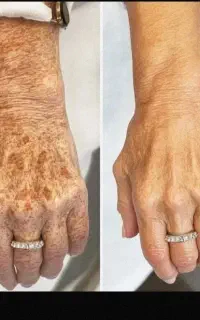 تضمینی لک هاتو درمان کن