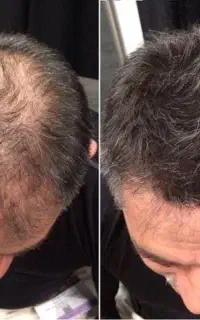 اگه ریزش مو داری پیام بده