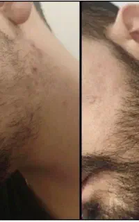 سیبیل و ریش پر پشت فقط تو ۲۵ روز
